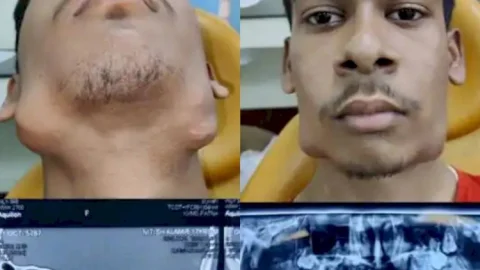 बिहार: 17 साल के नीतीश के मुंह में 82 दांत, जबड़े में ट्यूमर, IGIMS के डॉक्टरों ने किया ऑपरेशन