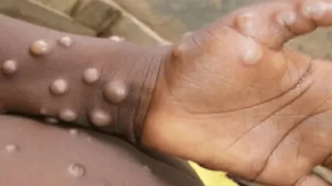 बिहार में मंकी पाक्स को लेकर अलर्ट, गवर्नमेंट ने जारी की गाइडलाइन