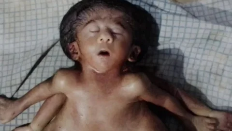 Bihar: छपरा में चार-चार हाथ-पैर वाले विचित्र बच्ची का जन्म, कुछ ही देर में हो गयी नवजात की मौत